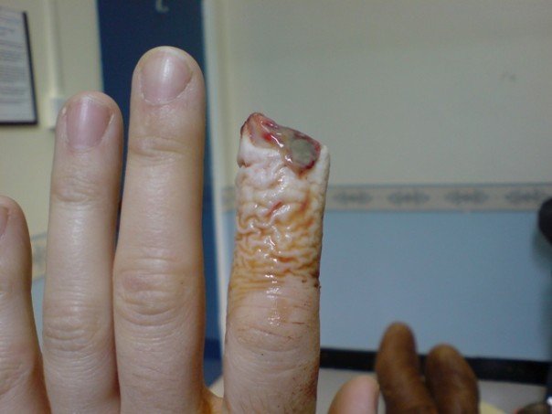 Sliced Finger In Disc Re Constructive Surgery On Wednesday